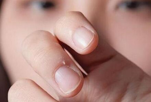 灰指甲是什么原因造成的