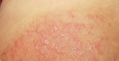 什么是真菌感染皮肤病