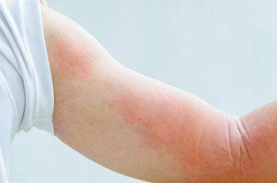 过敏性荨麻疹的症状和治疗