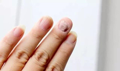 什么叫灰指甲?有哪些症状